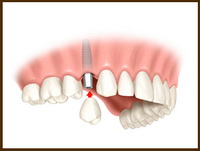 Особенности экспресс-имплантации зубов